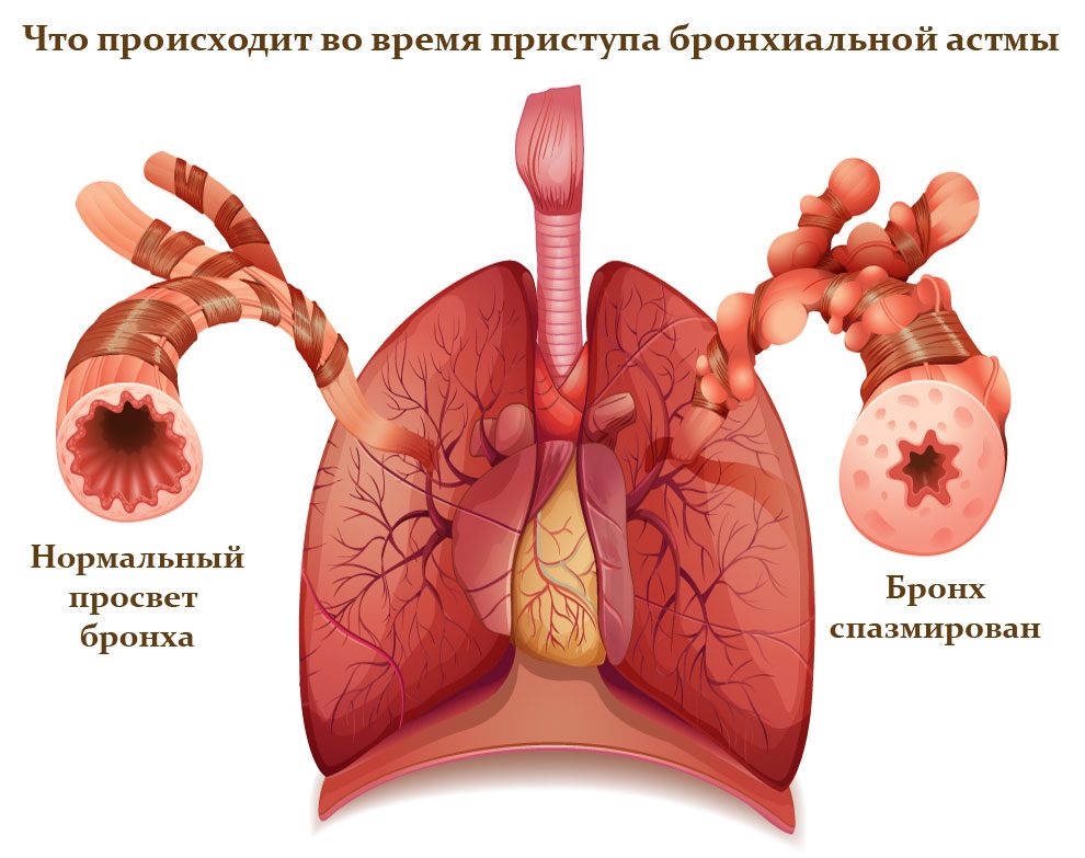 бронхиальная астма